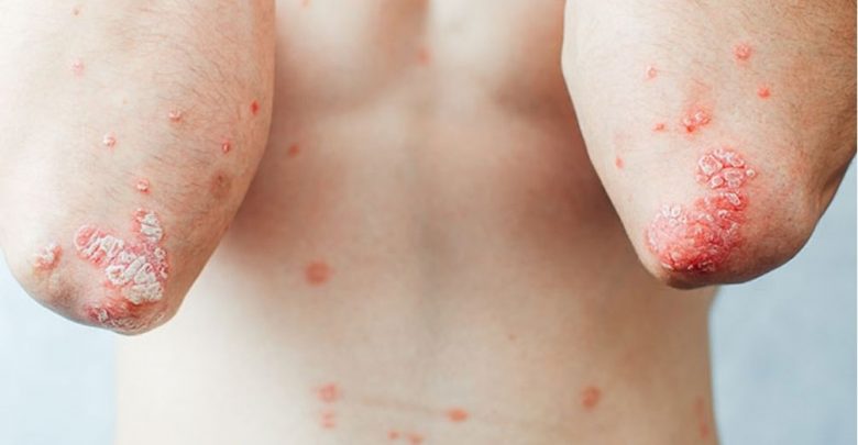 Psoriasis