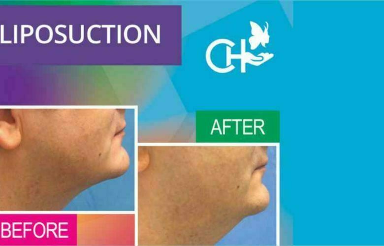 Liposuction Believed to be no longer a Slimming Technique