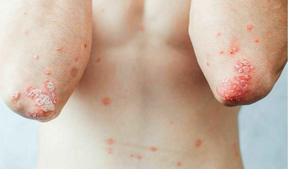 What is Psoriasis?